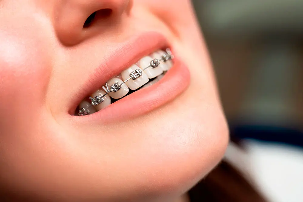 Brackets metálicos