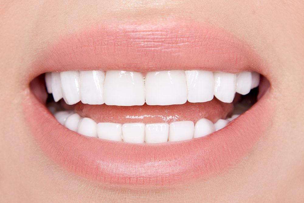 Blanqueamiento dental
