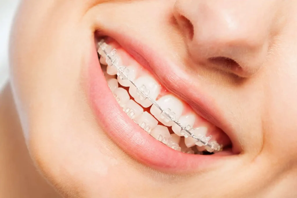 Brackets estéticos