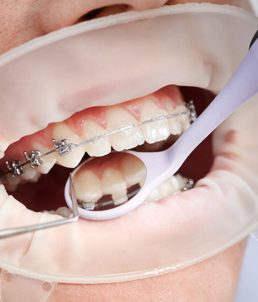 Control de brackets