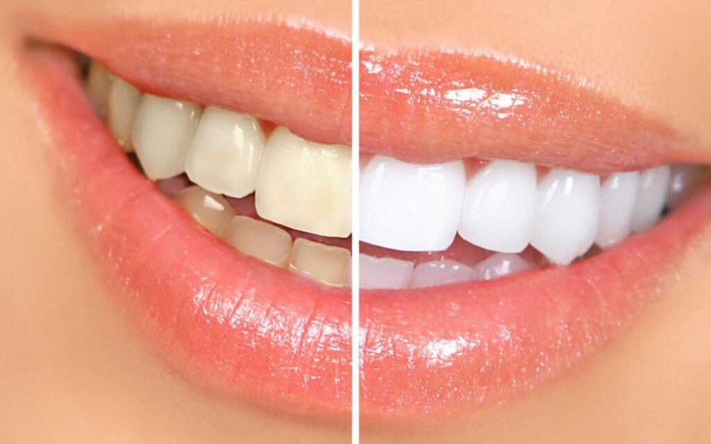Antes y después de un blanqueamiento dental